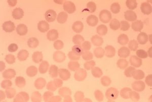 Malaria