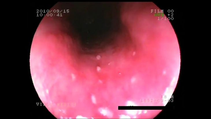Nyelocso Crohn